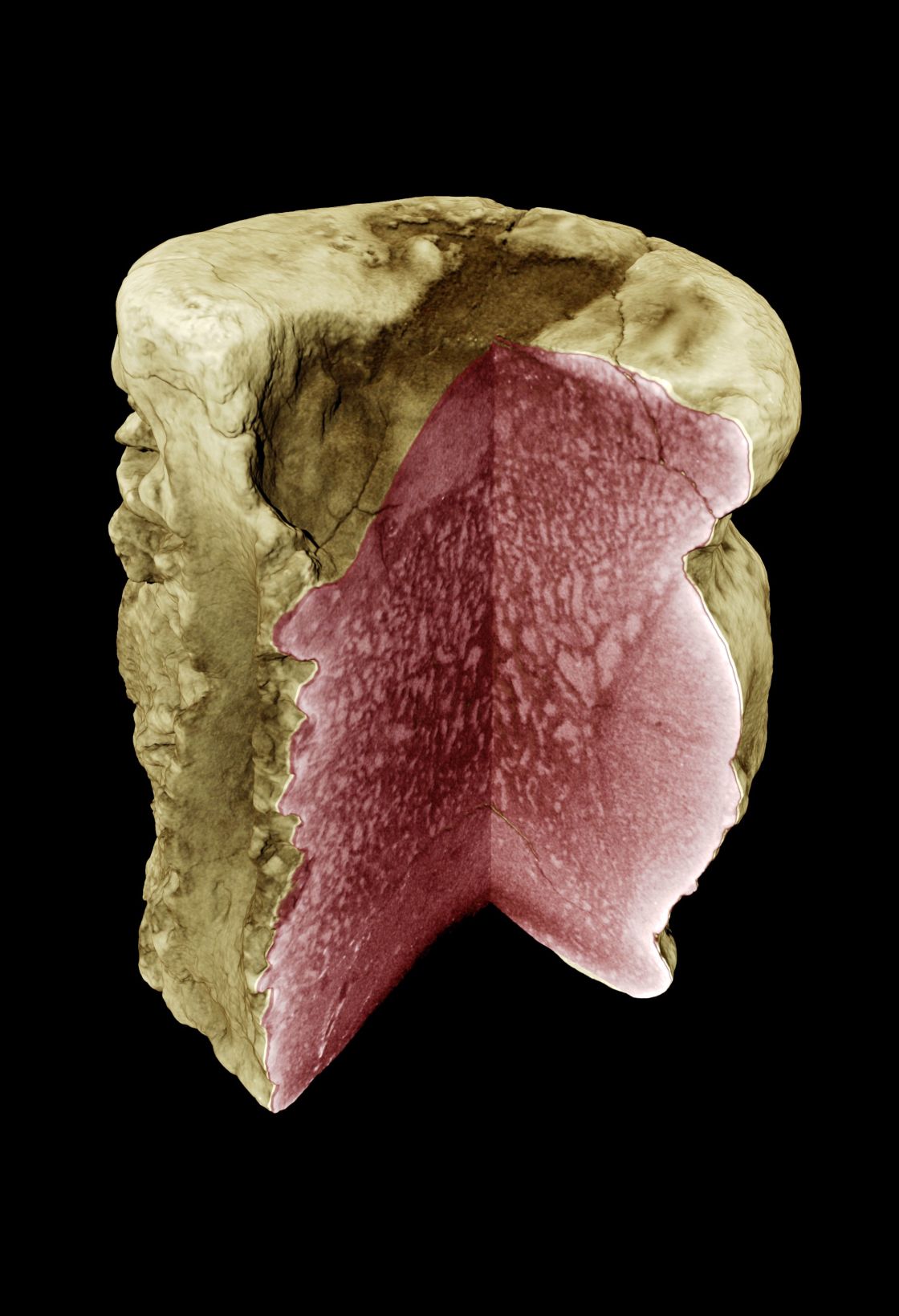 In dem Bild wurden mit Synchrotron-Holotomografie krankhafte Strukturveränderungen in einem Dinosaurierknochen sichtbar gemacht - vergrößerte Ansicht