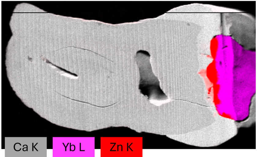 Das Kompositbild (aus den Daten der micro-XRF-Analyse) zeigt die Verteilung der Elemente Kalzium (Ca, wei&szlig;: Zahn) Ytterbium (Yb, magenta: F&uuml;llung) und Zink (Zn, rot: Sealer) in einem behandelten menschlichen Zahn. Dabei l&auml;sst sich erkennen, dass Zink aus dem Sealer-Material in den Zahn diffundiert.