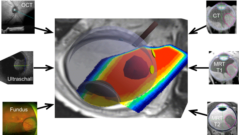 Bestrahlungsplanung auf Basis von fusionierter multi-modaler Bildgebung mit Bildern durch Optische Koh&auml;renztomographie, Ultraschall, Fotografie des Augenhintergrundes (Fundus), Computertomographie (CT) und Magnetresonanztomographie (MRT in T1 und T2-Gewichtung).